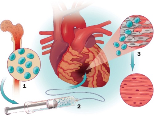 Терапия болезней сердца стволовыми клетками не вызывает оптимизма