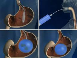 Эффективность внутрижелудочного баллона при ожирении