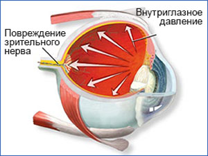 развитие глаукомы