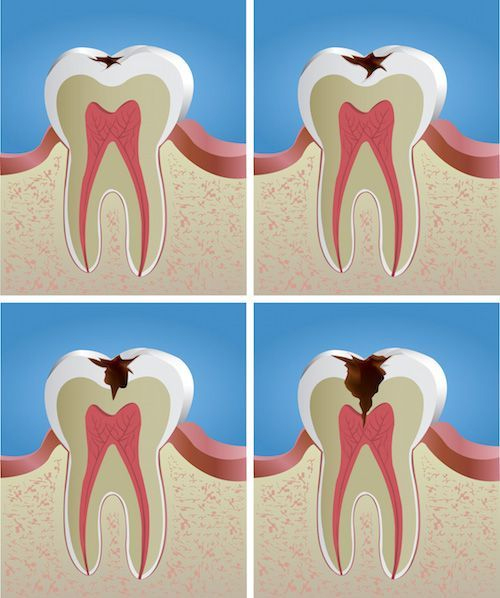 процесс разрушения твердых тканей зуба